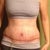 Day 10 Post Op.  Rash from my binder/garmet.  Heat related???