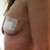 Side 1 day after removal of implants