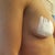 Side 1 day after removal of implants