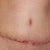 4 weeks PO - disappointed in how rough the scar still looks.