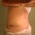 10wks post op........my left hip is finally healing really good after that stitch came out