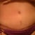 10wks post op.......my right hip is alittle swollen still but the left side is finally completely flat.....and i have the swimsuit bottom pulled down to show the scar