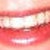 Invisible braces!