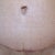 5 weeks post op. TT scar.