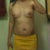 5 days post op