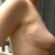 1 month post op