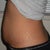 Side view: 9 days before surgery.