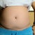 Before surgey....white wide belly