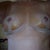 am thinking i might end up with one breast, the left, larger and a bit lower than other one.  I hate to be picky after such a vast improvement, but still hoping thay will be a bit more even after some tome goes by.