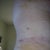 some of the bruising to my flanks that wasn't even there until yesterday.  The other side, my back and one side of my butt look a bit worse.  Doesn't bother me at all...am so glad he did some lipo to help blend/contour my belly into my upper hip/flanks.  It's ouchy, but no big deal.
