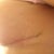 Side scar almost invisible