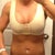 One day post op