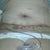 4 days post opp