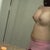 post-op day 11
