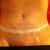 1 week po from incision revision.. So Happy!!