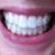 With aligners in, buttons on top and bottom