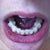 Without aligners in, bottom teeth progress tray 7 (about 3 months)