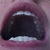 Without aligners, top teeth progress tray 7 (about 3 months)