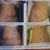 This is before my lipo...and after. Smoothed it out dramatically!!!
