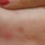 Day 16 post op. Scar letf side.