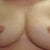 Day 16 post op.