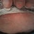 scar at about 6 weeks after surgery. not it is redder bc its healing