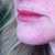 Day 10 - much improved but still swelling above top lip.