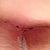 Under my left breast. 11 days post op.