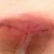 Under my right breast. 11 days post op.