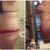 Before and 6 months post op