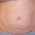 Before surgery