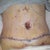 5 days post op