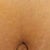 Belly Button Post Op Day 13.