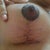 Right Breast Post Op Day 13.