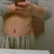 5 weeks 1 day po. This is the rt side that needs some lipo.