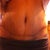 4 weeks, 4 days PO - scar