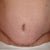 7 weeks - My scar reminds me of Iron Man's helmet!