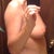 Side view in the buff before surgery.