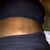 4 days post op