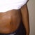 12 days post op- I've got a lot of stretchmarks, but that's fine because it doesn't look like the above photo.