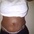 12 days post op- bizarre swelling and knots at the areas that were liposuctinoed.