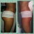 B4 pic & 1 month post op