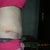 Day 19 post op side view...