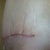No real change in swelling from week three. Post op one month