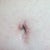 One month post op