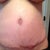 There's a bit of bulging above the incision, but it's where I still have stretch marks. Plus I'm swollen a bit. So we'll wait n see!