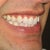 Before Starting Invisalign