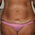 This was before surgery