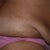 This was before surgery