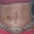 This is 8 days after surgery
